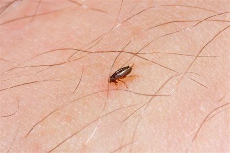 How Do I Get Rid Of Fleas In My Hair Effective Solutions Revealed