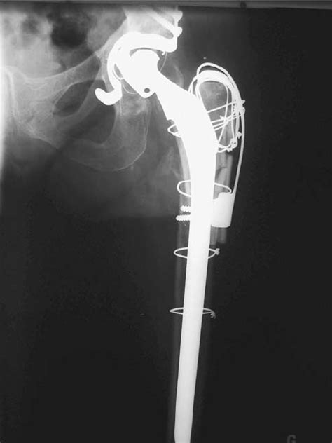Radiograph Showing Claw Plate Fixation Of The Trochanteric Osteotomy