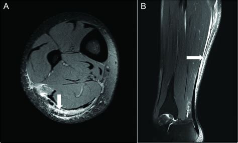 Connective Tissue Injury In Calf Muscle Tears And Return To Play Mri