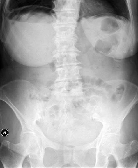 Abdominal X Ray Showing Pneumoperitoneum With Free Air Under The