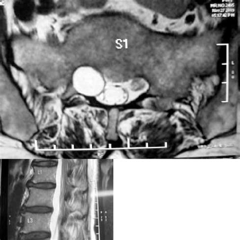 Magnetic Resonance Imaging Showing A Tarlov Cyst At The L4l5 Vertebrae