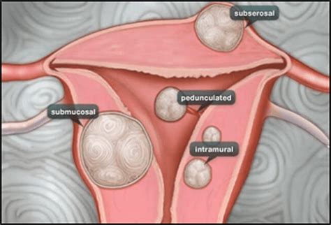 Uterine Fibroids And Fertility Feto Maternal Medical Centre Doha