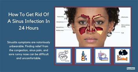 How To Get Rid Of A Sinus Infection In 24 Hours Causes Duration