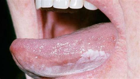 Bumps On The Tongue Causes Picture Symptoms And Treatment