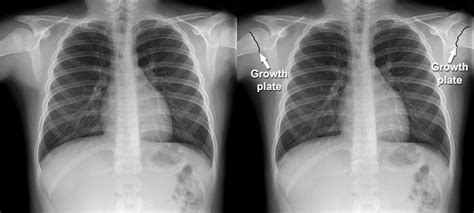 Chest X Ray Quality Normal Chest X Ray Changes With Age