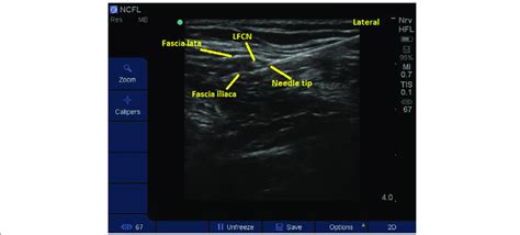 Ultrasound Image Of The Lateral Femoral Cutaneous Nerve Lfcn Lateral