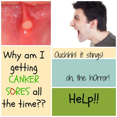 Common Causes Of Canker Sores Hubpages