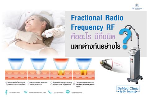 Fractional Radio Frequency RF คืออะไร มีกี่ชนิด แตกต่างกันอย่างไร ? - Demedclinic
