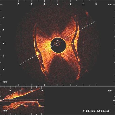 Pdf Optical Coherence Tomography For Endodontic Imaging Art No F