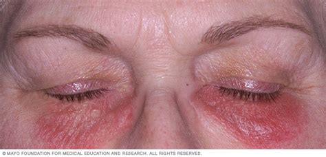 Dermatitis De Contacto Síntomas Y Causas Mayo Clinic