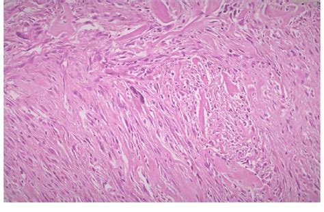 Histopathologic Picture Of Myofibroblastic Sarcoma Download