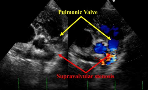 Right Parasternal Short Axis View At The Pulmonic Valve Level A