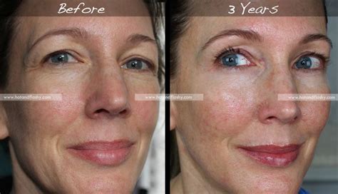 Retin A For Wrinkles 3 Year Results Before And After Hotandflashy