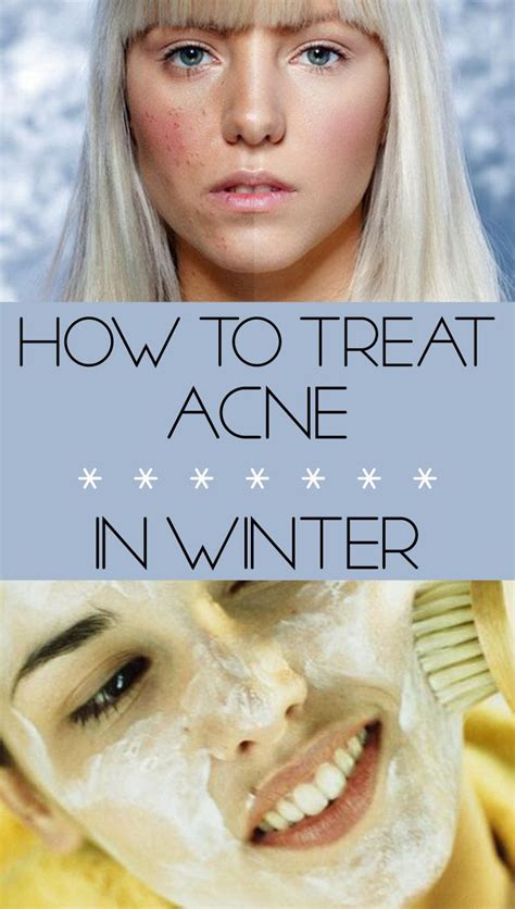 How To Treat Acne In Winter Beauty How To Treat Acne