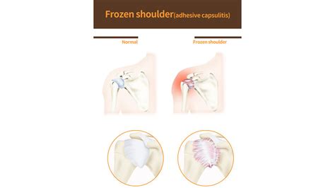 Frozen Shoulder Adhesive Capsulitis Treatment