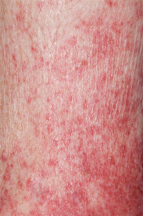 Petechial Rash Photograph By Dr P Marazziscience Photo Library