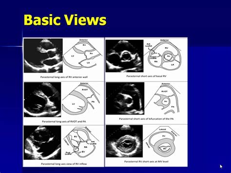 Echocardiography Of The Right Ventricle Youtube