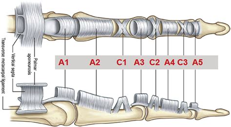 Release Of The A4 Pulley To Facilitate Zone Ii Flexor Tendon Repair