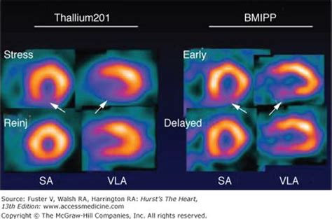 Nuclear Cardiology Thoracic Key