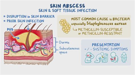 Skin Abscess Clinical Sciences Osmosis Video Library