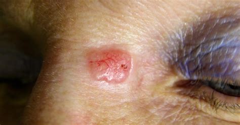 Best Drs And Hospitals In India For Skin Cancer On Nose Treatment