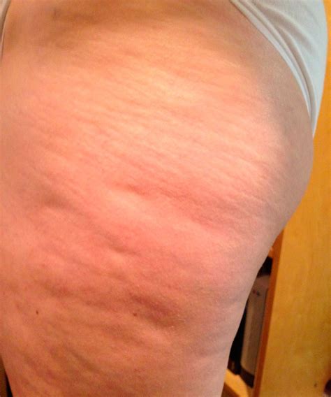 Collection Pictures Pictures Of Cellulite On Stomach Sharp