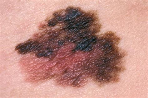 Melanoma Skin Cancer NHS