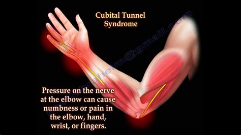 cubital tunnel syndrome ulnar nerve entrapment everything you need to know dr nabil