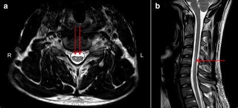 T2 Weighted Mri At The Level Of The Cervical Spinal Cord Of The Case