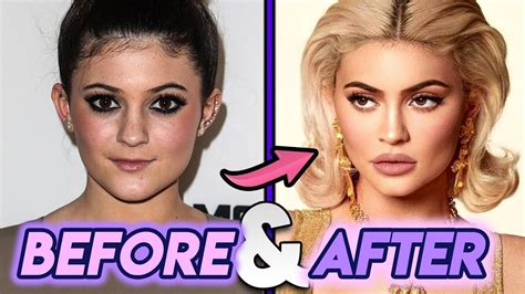 Kylie Jenner Before And After Transformations Plastic Surgery Updated