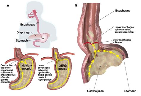 Pdf Current Advancement On The Dynamic Mechanism Of Gastroesophageal