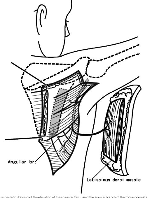 Figure 1 From Versatility Of Chimeric Flap Based On Thoracodorsal