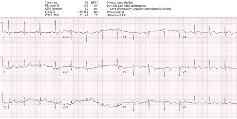 Wellens Syndrome Reperfusion And Reocclusion Mi Ecg Cases Em Cases