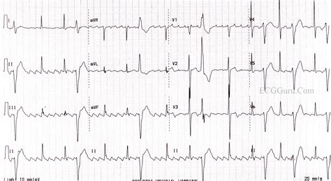The 12 Lead Ecg Shows A Typical Atrial Flutter With Regular And Images