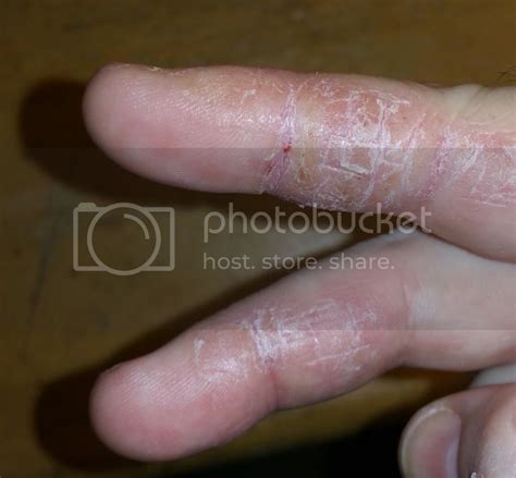 Dry And Cracked Skin On Fingers Several Years Now And Fed Up Skin