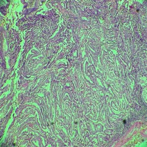 Different Patterns Of Positive P16 Staining In Cin Ilsil Upper Line