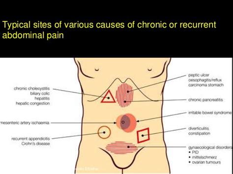 Abdominal Nerve Pain Left Side Ovulation Symptoms
