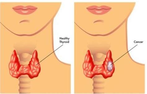 Metastatic squamous neck cancer with occult primary treatment. Head And Neck Cancer - Throat Cancer Symptoms | Kimaja ...