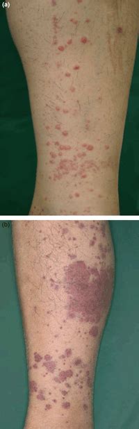 Characteristics Of Allergic Purpura Lesions Include Which Of The Following