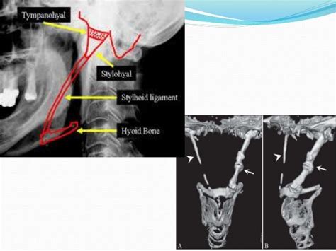 Soft Tissue Calcification Of Head And Neck