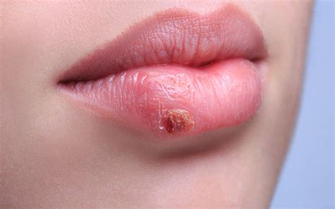 How To Identify Whether You Have A Pimple Or A Cold Sore Vedix
