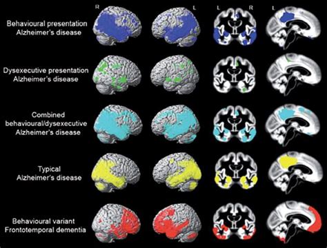 'Frontal AD' a Misnomer? Behavioral Variant Has Minimal Frontal Atrophy ...