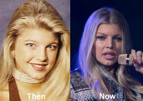 53 Celebrity Plastic Surgery Gone Wrong Before And After