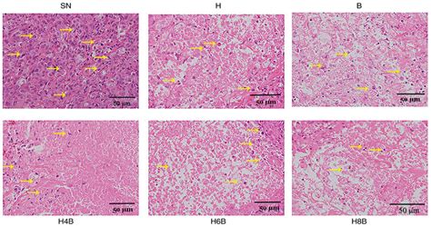 Pathological Assessment By HE Staining HE Staining Of Prostate Cancer