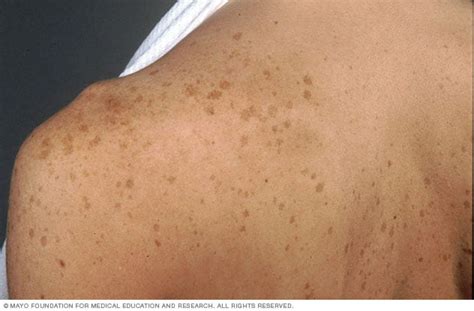 Age Spots On The Shoulder And Back Mayo Clinic