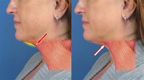 Case Study Of Neck Liposuction Plastysmaplasty In San Diego Ca