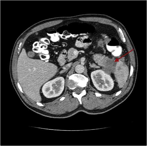 Staging Ct Scan Tumor Of The Tail Of The Pancreas Invading The Spleen