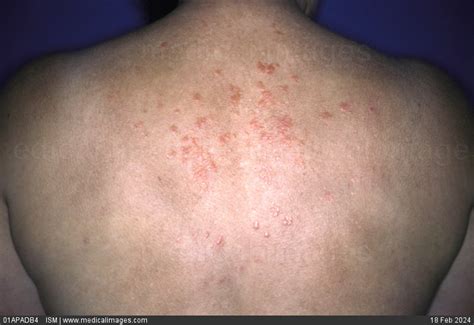 Stock Image Cutaneous Sarcoidosis Of The Back Sarcoidosis Is A
