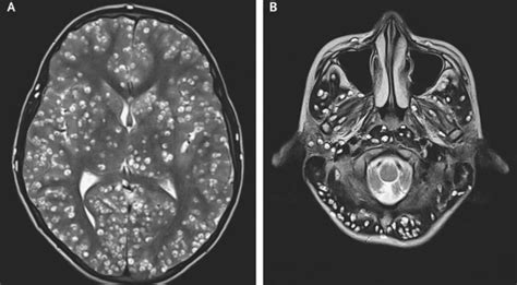 Mri Of Brain Infected With Tapeworm Parasites Did That Just Really