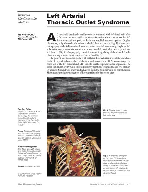 Pdf Left Arterial Thoracic Outlet Syndrome